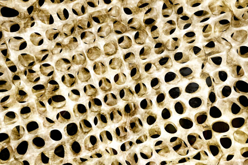 Osteoporóza (riedke kosti) je ochorenie látkovej výmeny kostného tkaniva, ktorá sa prejavuje ubúdaním množstva kostnej hmoty a poruchami mikroarchitektúry kosti, čo vedie k oslabeniu pevnosti kosti a tým k zvýšenej lámavosti.