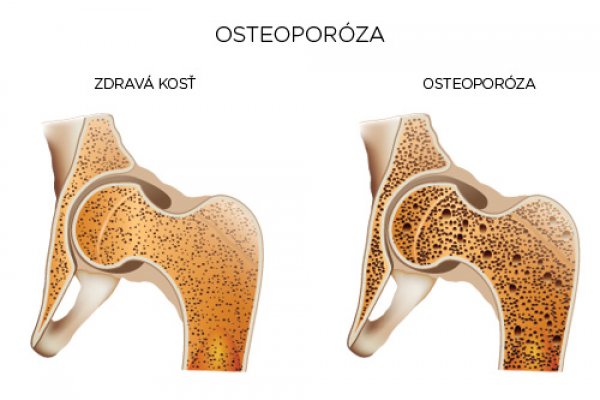 Je osteoporóza nezvratná?