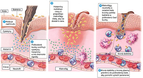 Zápalové reakcie v ľudskom tele.
