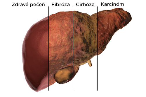 Ochorenia pečene.