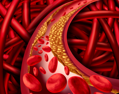 Ateroskleróza - cholesterol uložený na stenách ciev a brániaci prietoku krvi.