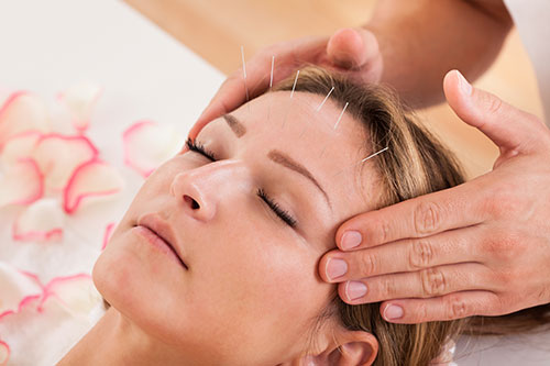 Liečba bolesti hlavy akupunktúrou 