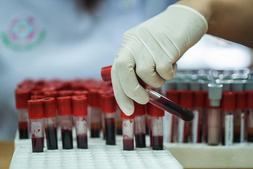 Kvapalinová biopsia je metóda okrem iného aj na rýchle zistenie nádorov pomocou krvného testu. 