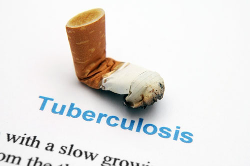 Nepodceňujte tuberkulózu a zvýšenú pozornosť venujte hygiene a nefajčite.