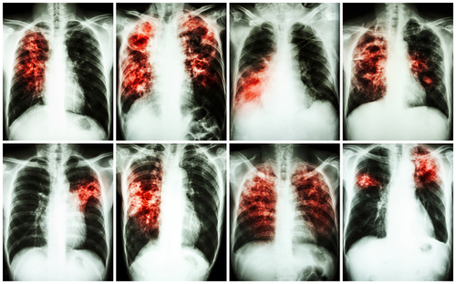 Infekčné choroby tuberkulóza a AIDS sa často vyskytujú spoločne.