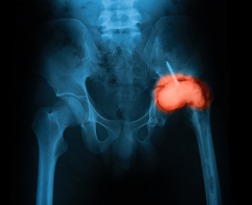 Kalcifikácia v oblasti kĺbov zabraňuje kvalitnému pohybu kostry.